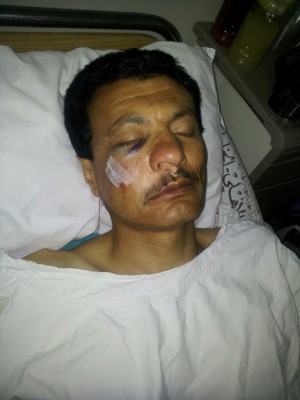 Demonstrator Ameen Bayed after having been hit in the face with a tear gas canister.