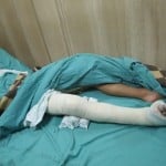 The young Qaryut boy here has his entire right leg in a cast, expecting a potential surgery.
