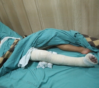 The young Qaryut boy here has his entire right leg in a cast, expecting a potential surgery.