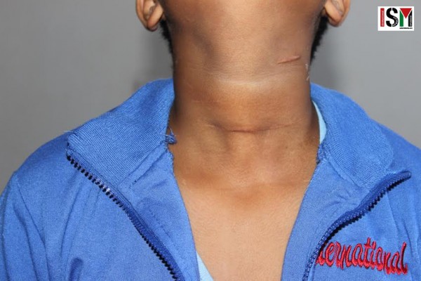 Mohamed with visible scars on his neck.
