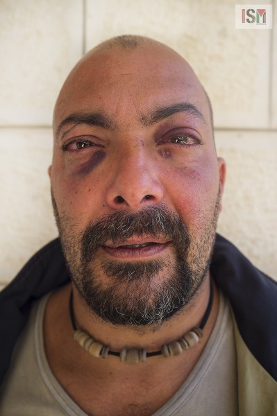Italian acitivist Antonio Fresta photographed day after been arrested and beaten by the police.