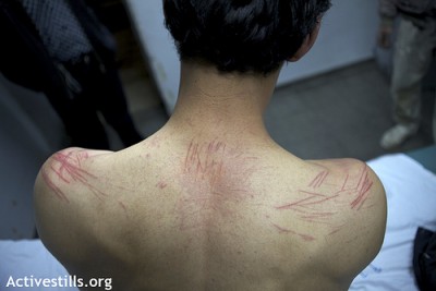 Lacerations on the back of a Palestinian organizer who was tortured in Israeli jail before being released with no charges.