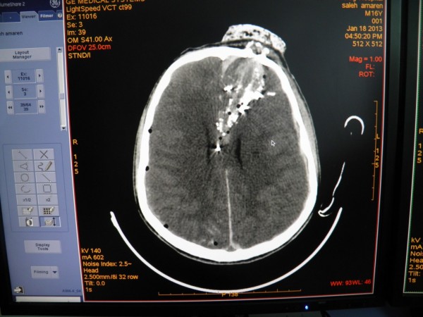 X-ray showing fragmentation of the bullet within Saleh's head