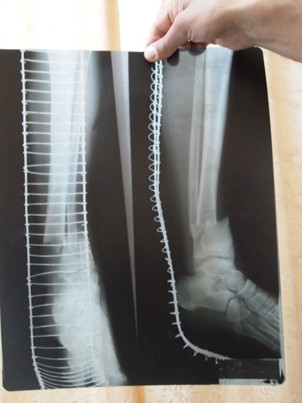 Nablus' Rafidia Hospital took this X-ray showing the teenager's broken bones from his attack (photo: ISM)