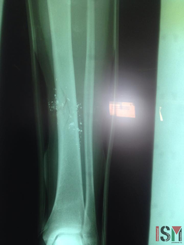 X-ray photo showing the shattered bone caused by a .22 caliber bullet (photo ISM)