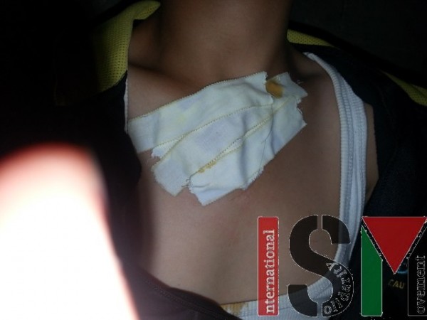 13 year old Abdullah Daana was injured by settler-thrown molotov. 