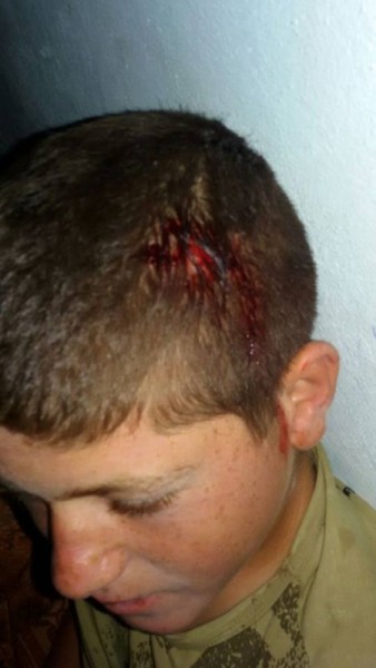 Injured Palestinian kid Photo credit: Operazione Colomba