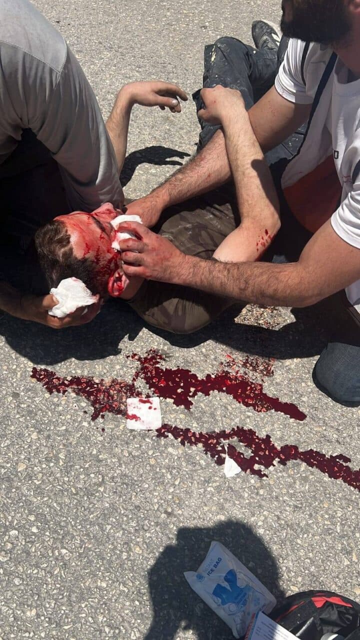 Man with face injury after settlers and Israeli army attacked residents of Huwara, burnt their land and stole sheep