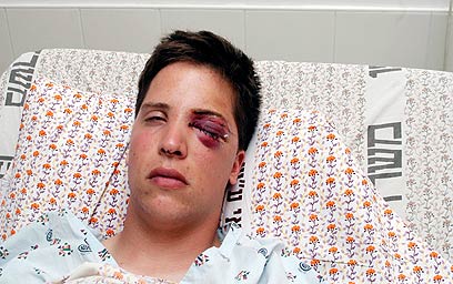 Matan Cohen after being shot in the eye by a 'rubber bullet'